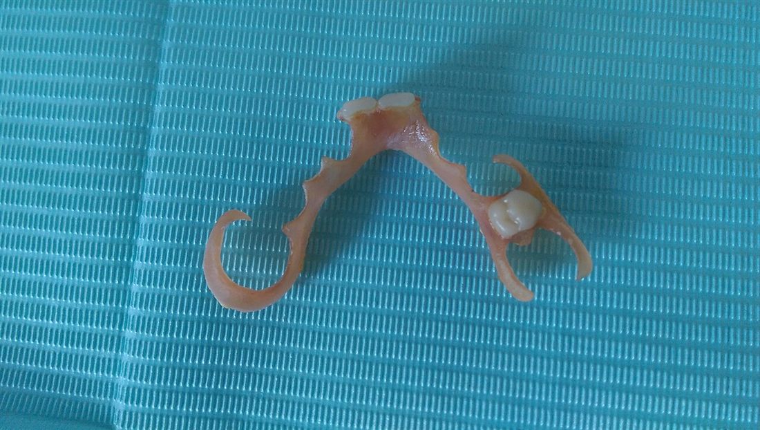 A flexible nylon partial denture