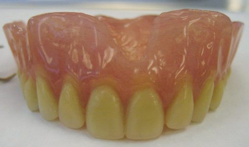 An immediate denture ready to be placed after extraction