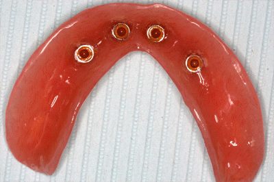 The underside of an implant overdenture showing the attachment housings
