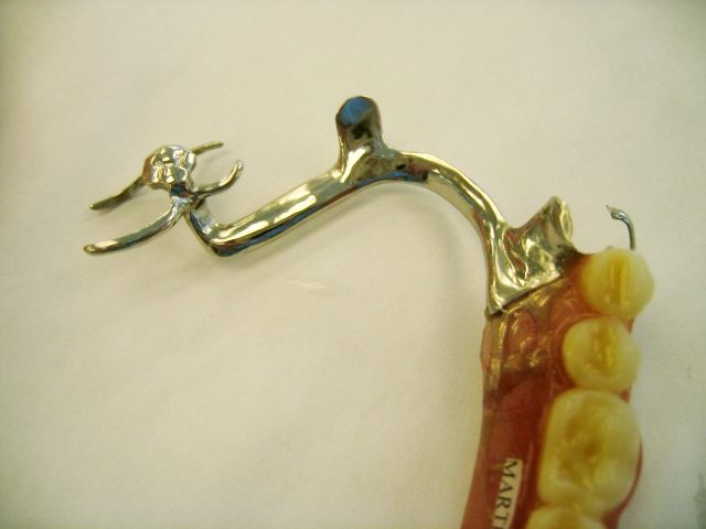 A removable partial denture with a metal clasp